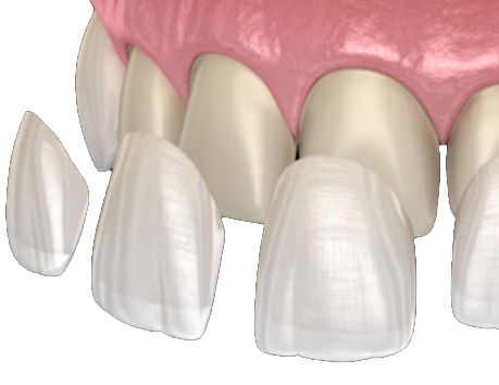 Faccette Dentali