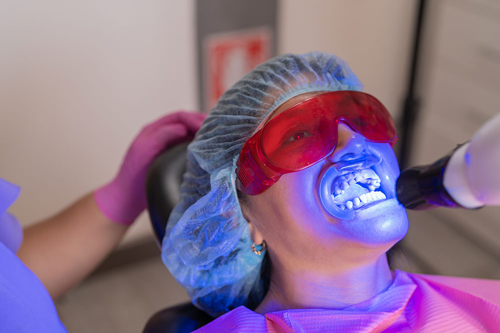 sbiancamento denti a lugano