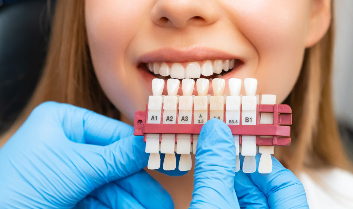 sbiancamento denti lugano