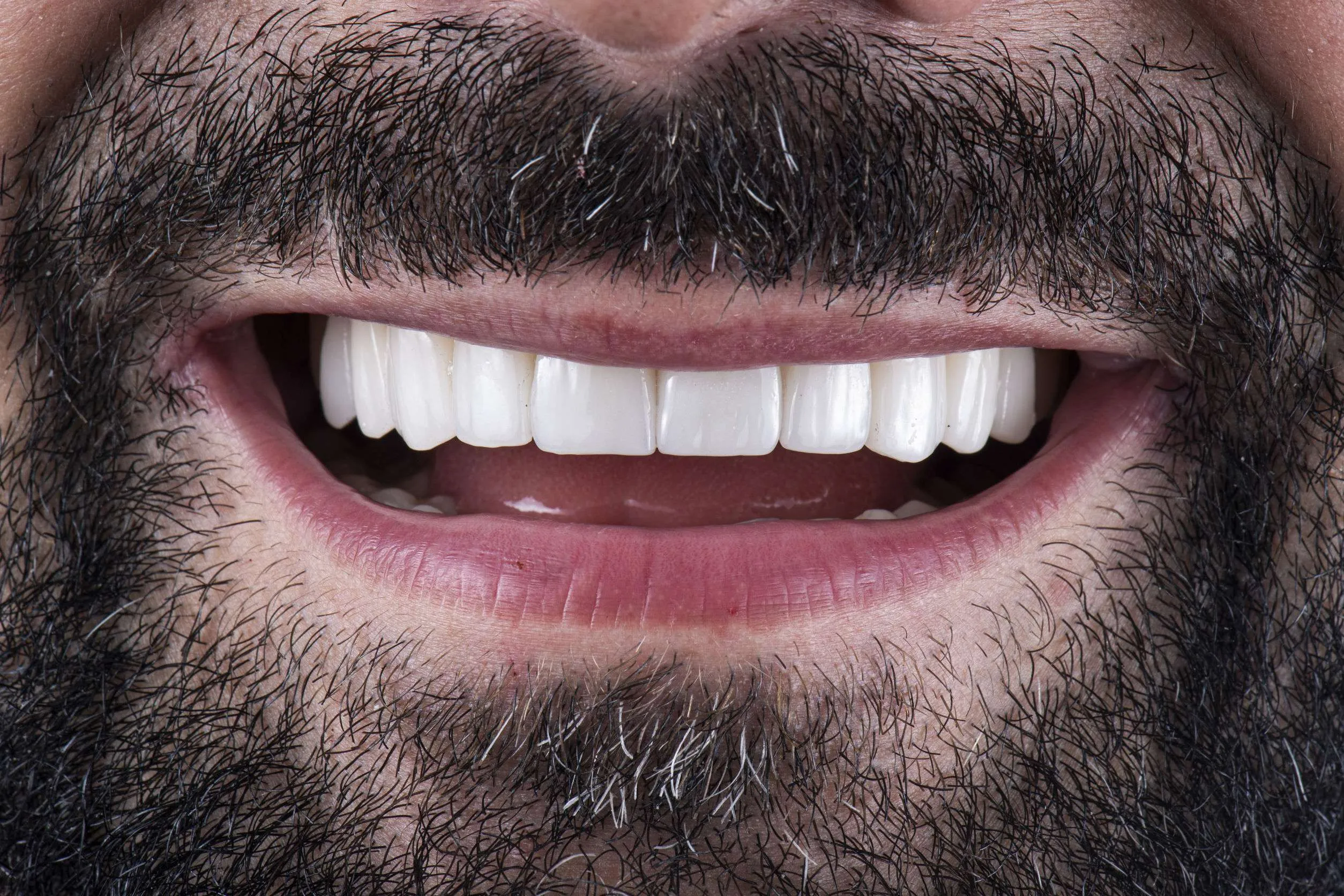 faccette dentali lugano durata faccette dentali veneers lugano